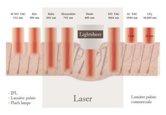 laser-lightsheer-diode-luxembourg